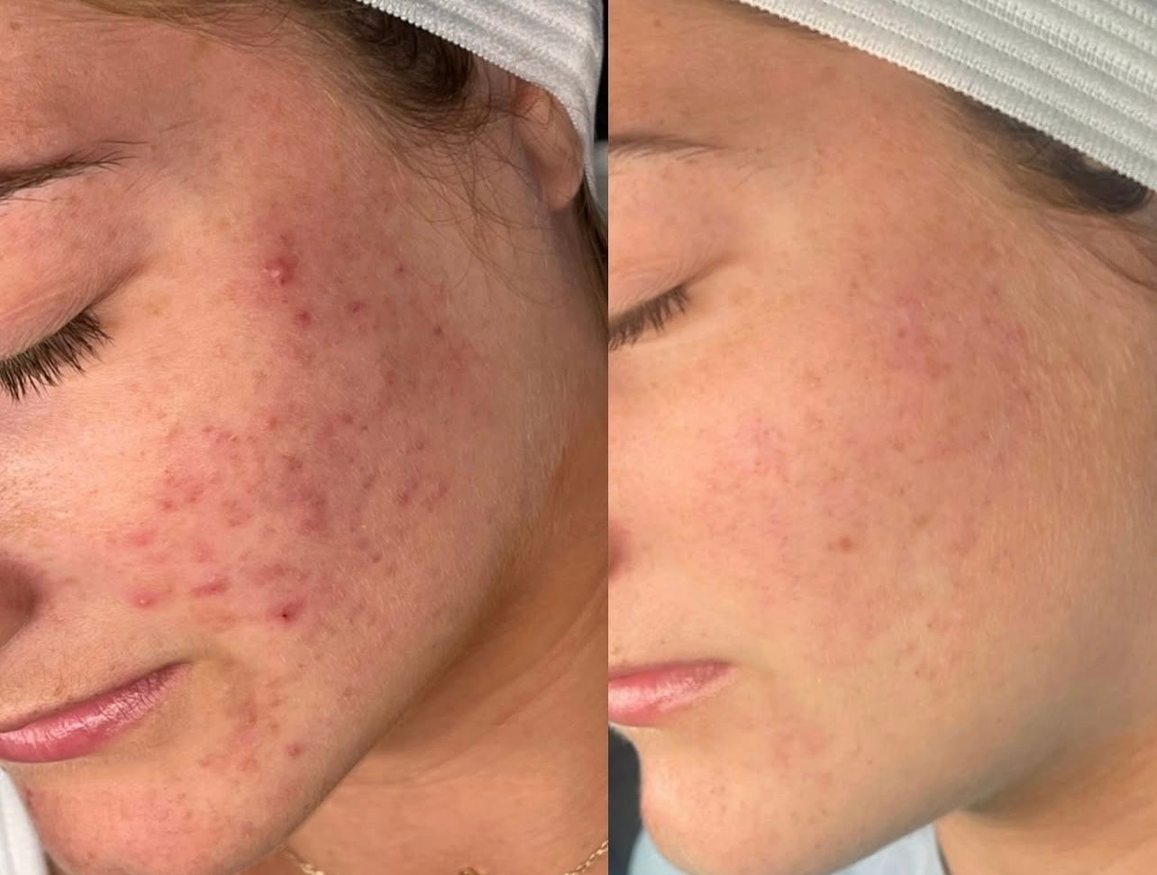 Side-by-side close-up of a cheek before and after acne treatment, showing clearer skin on the right.