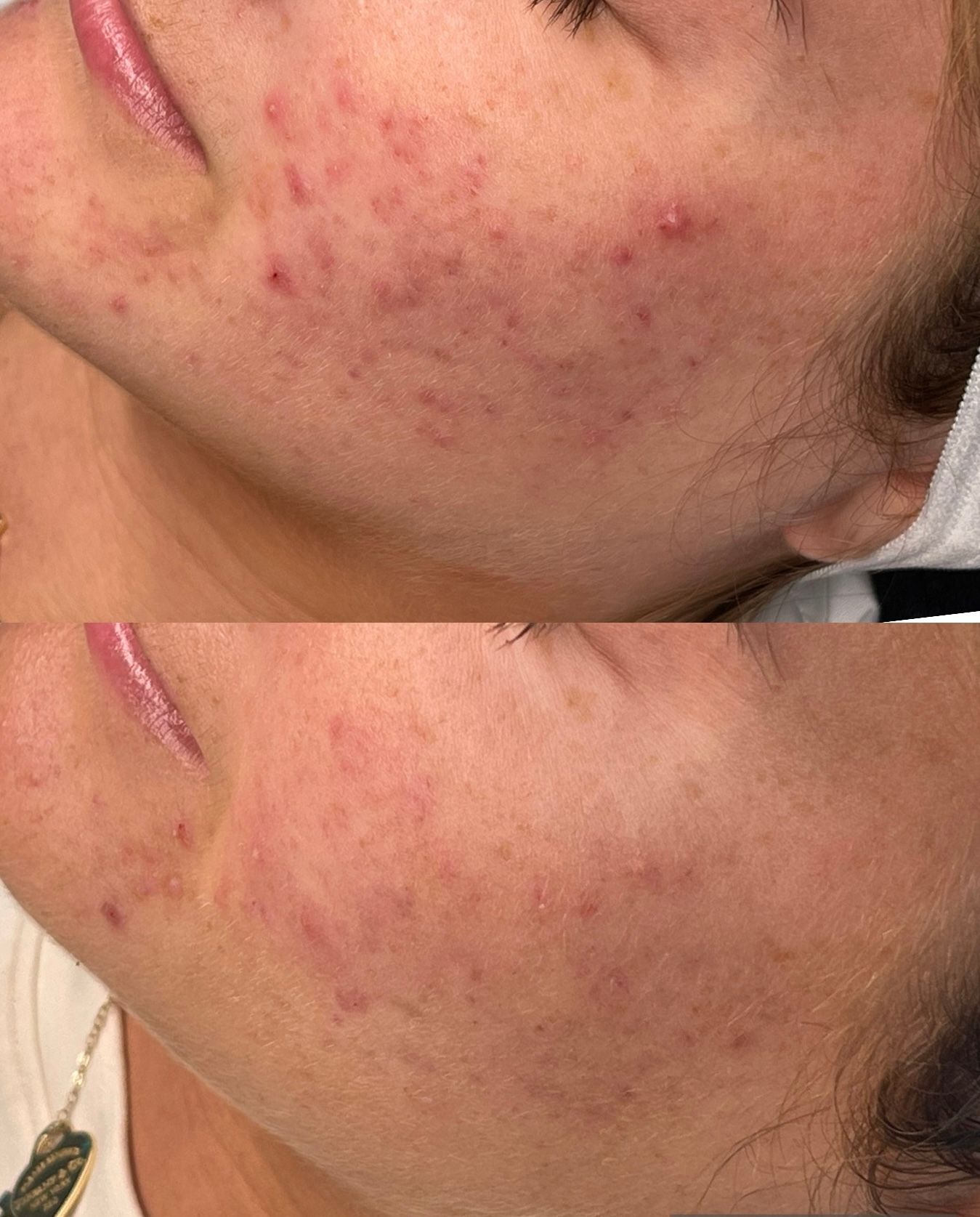 Close-up side-by-side of a cheek with red acne blemishes before and after treatment