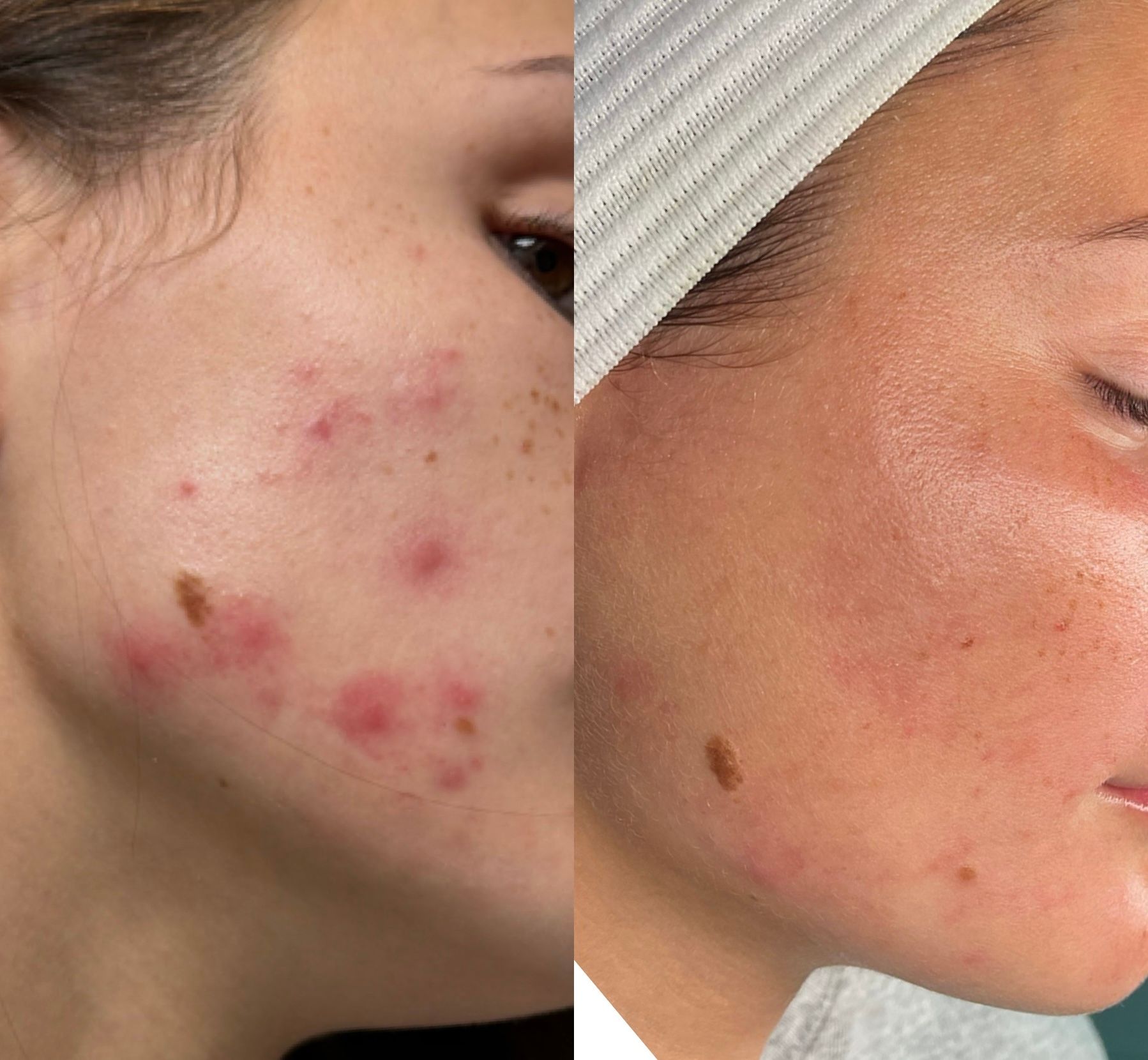 Side-by-side close-up of a cheek with acne spots, showing before and after skincare results