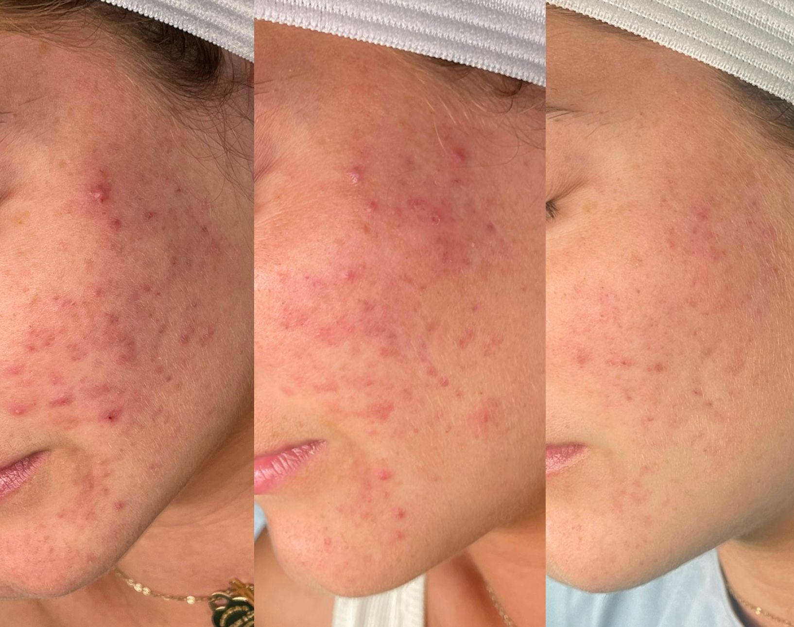 Three side-by-side close-ups of a cheek with acne and redness, showing skin progress over time