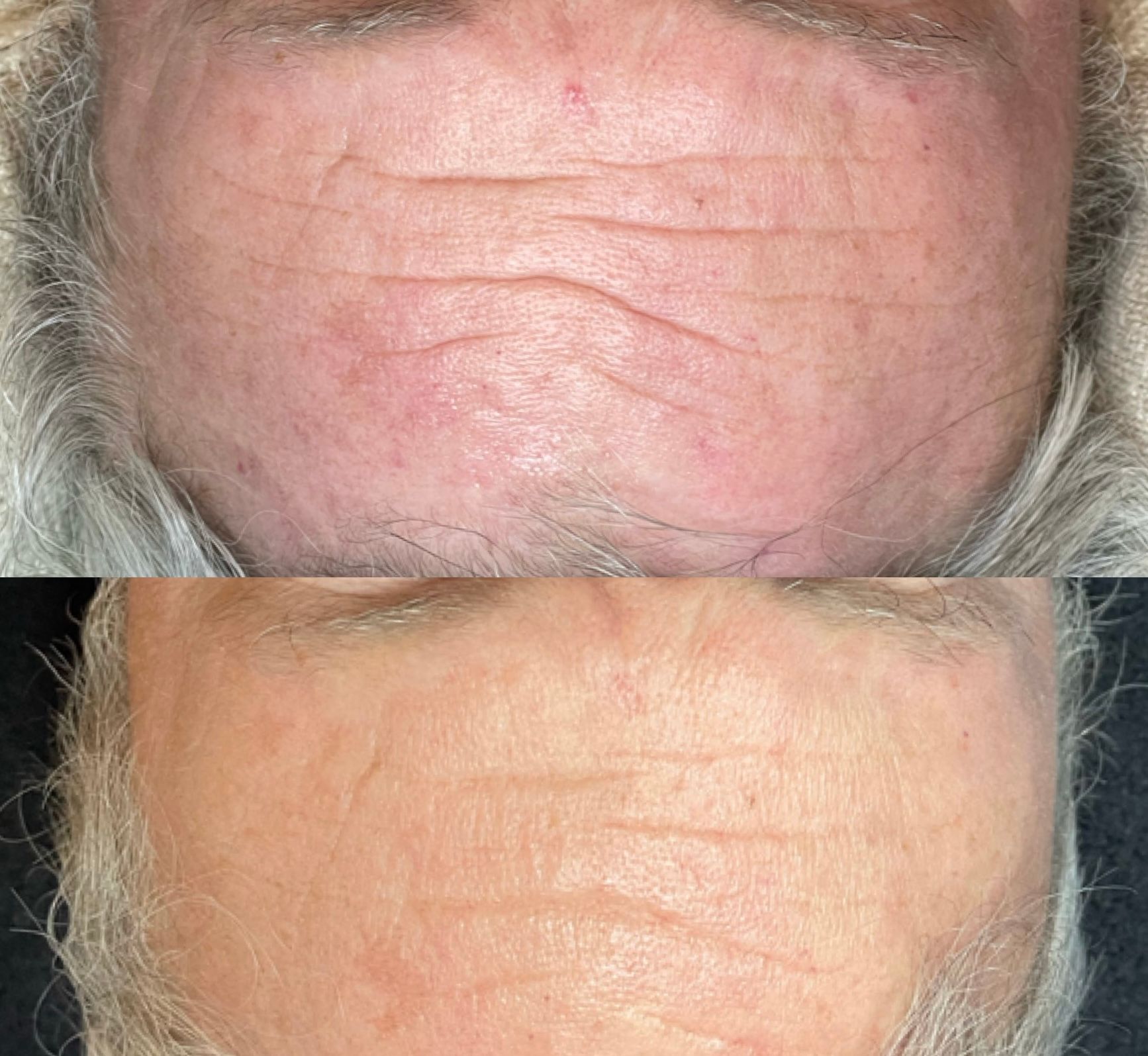 Close-up of a forehead showing wrinkled skin in a before-and-after comparison