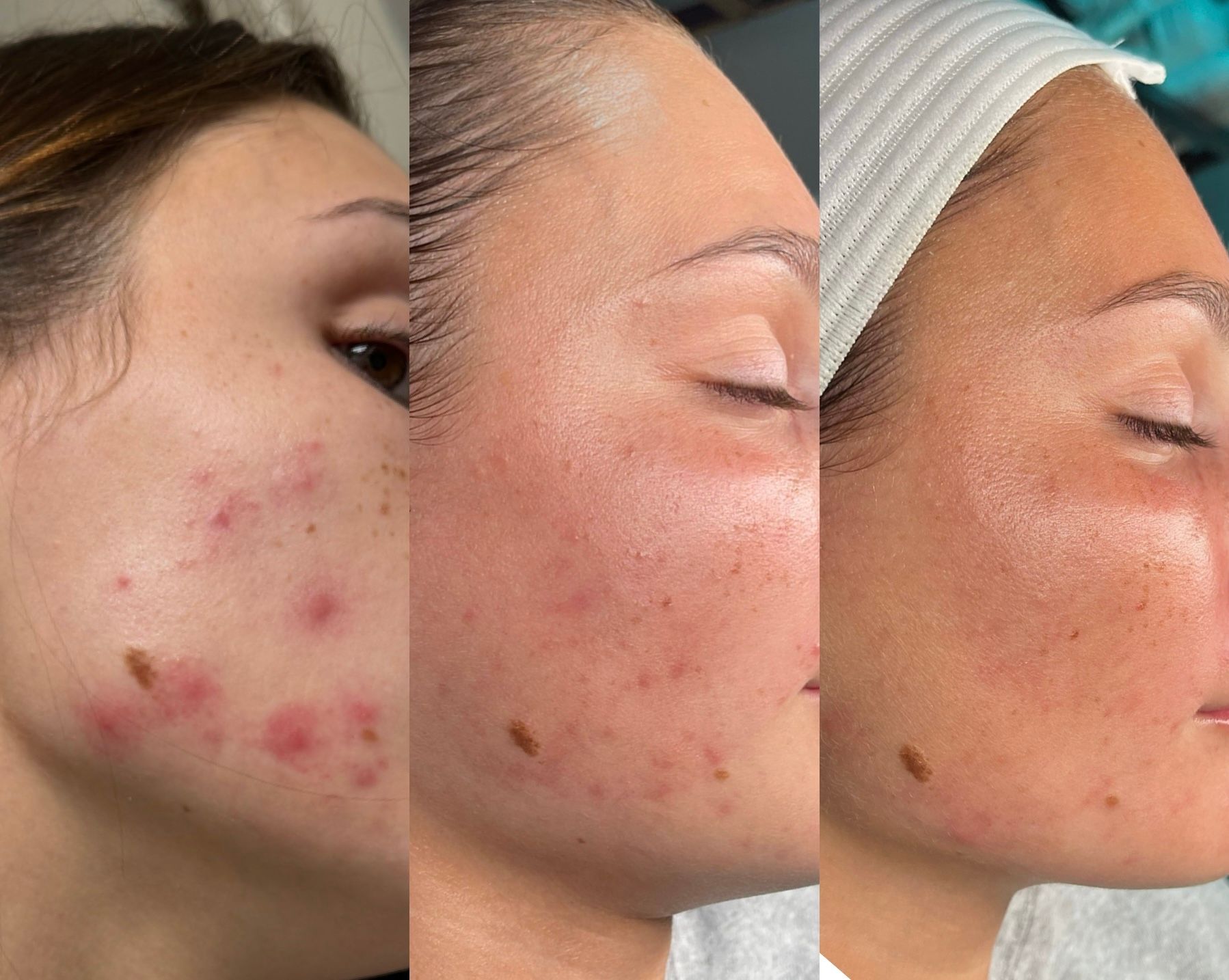 Three side-by-side profile photos show facial acne before and after treatment improvement.