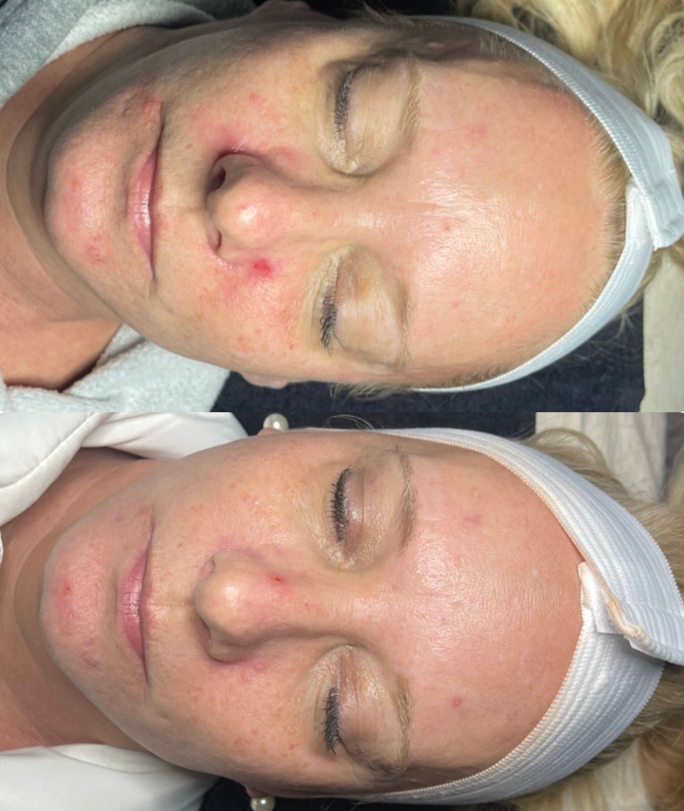 Two close-up photos of a woman’s face with red acne-like spots and a headband, eyes closed.