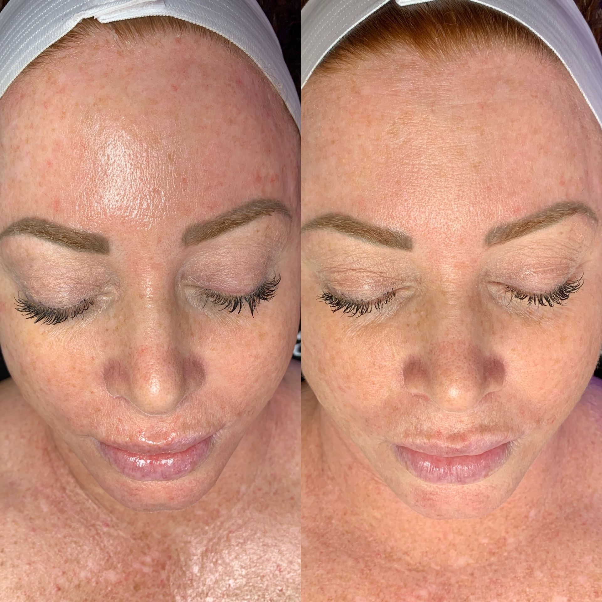 Two side-by-side close-up faces with a white facial mask and eyes closed, shown before and after treatment