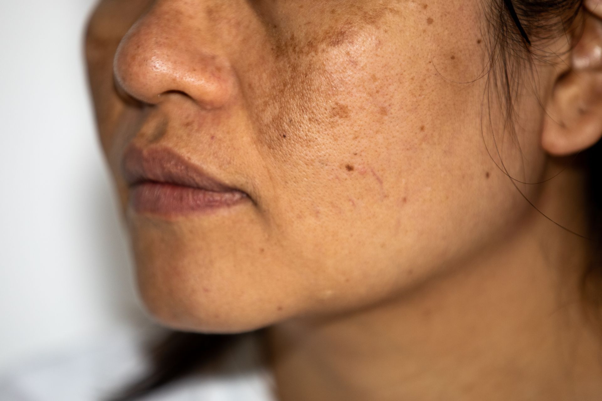 Close-up side profile of a face with visible dark freckles and blemishes on the cheek and nose