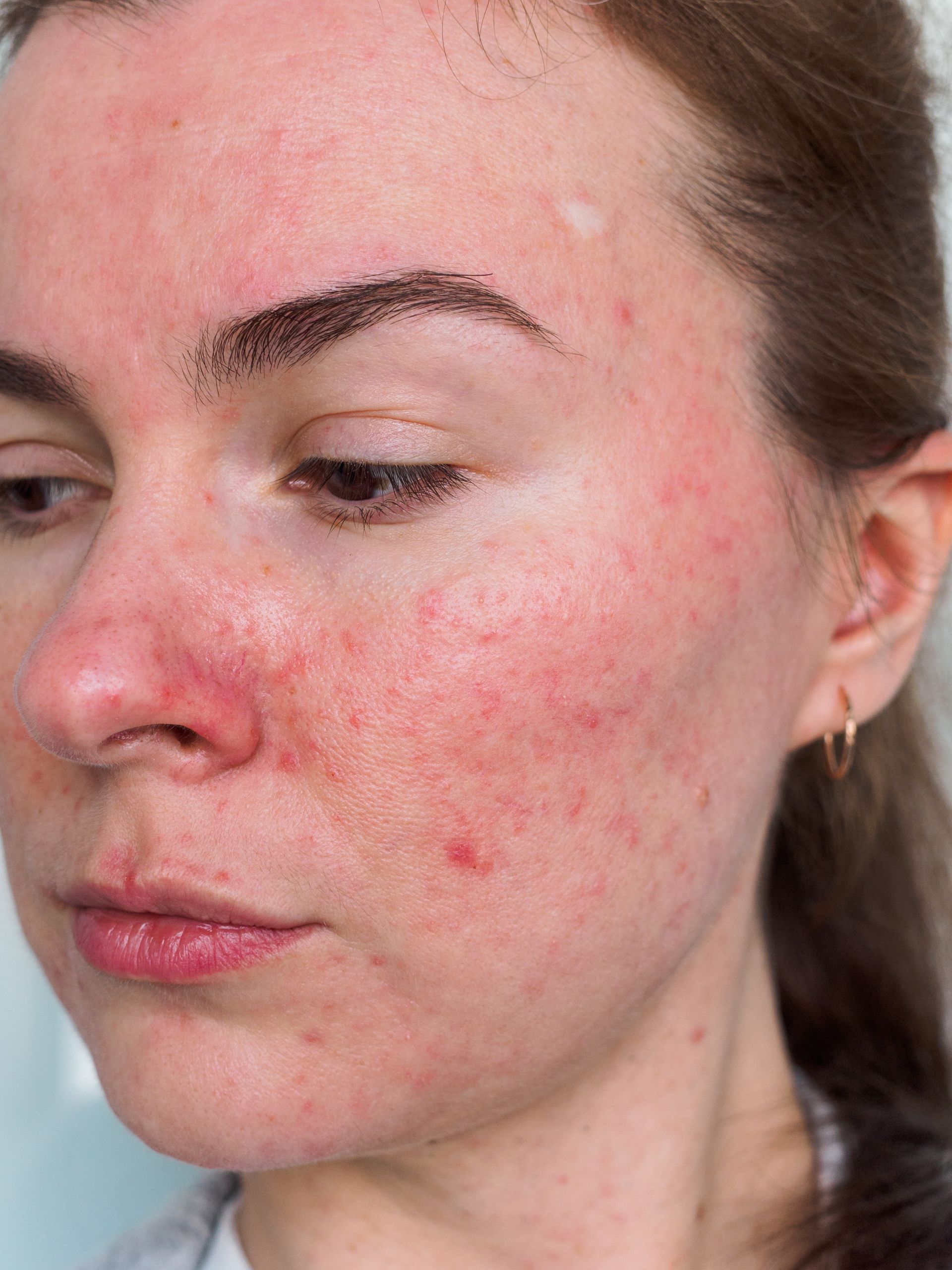 Close-up of a face with red, blotchy acne-like rash on the cheeks and nose