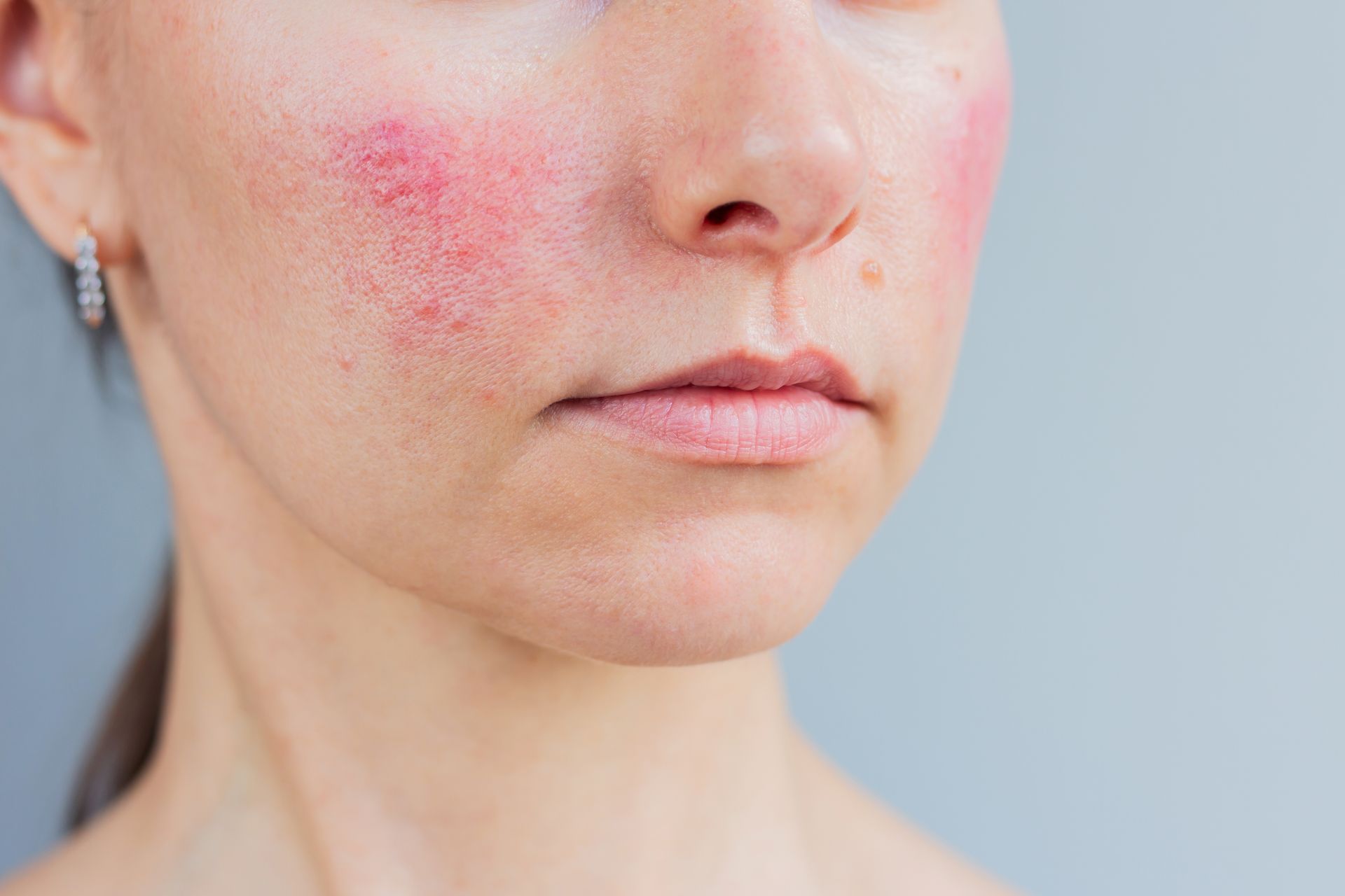 Close-up of a face with red, irritated cheeks against a light blue background