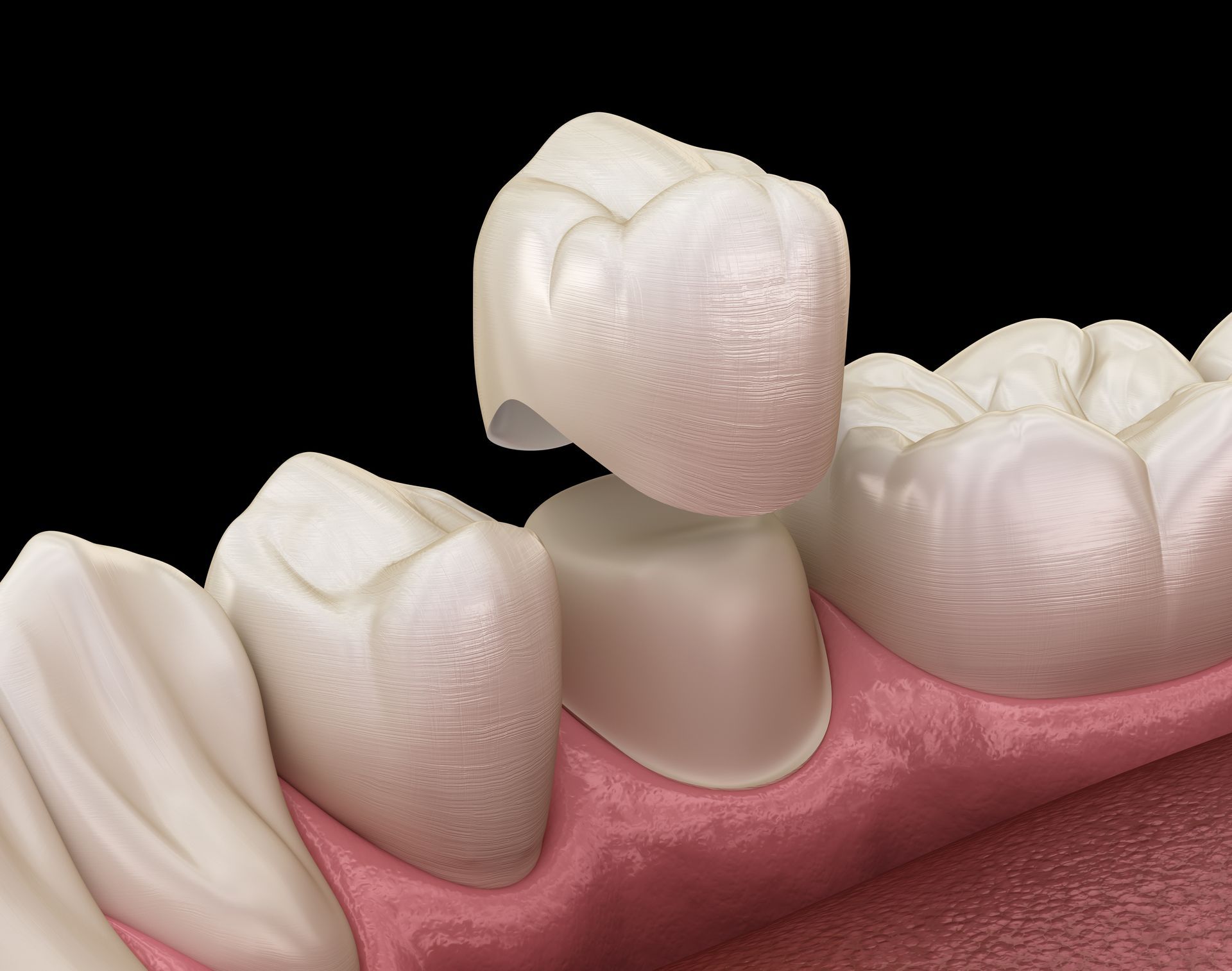 A crowned tooth above a prepared molar in a close-up dental illustration.