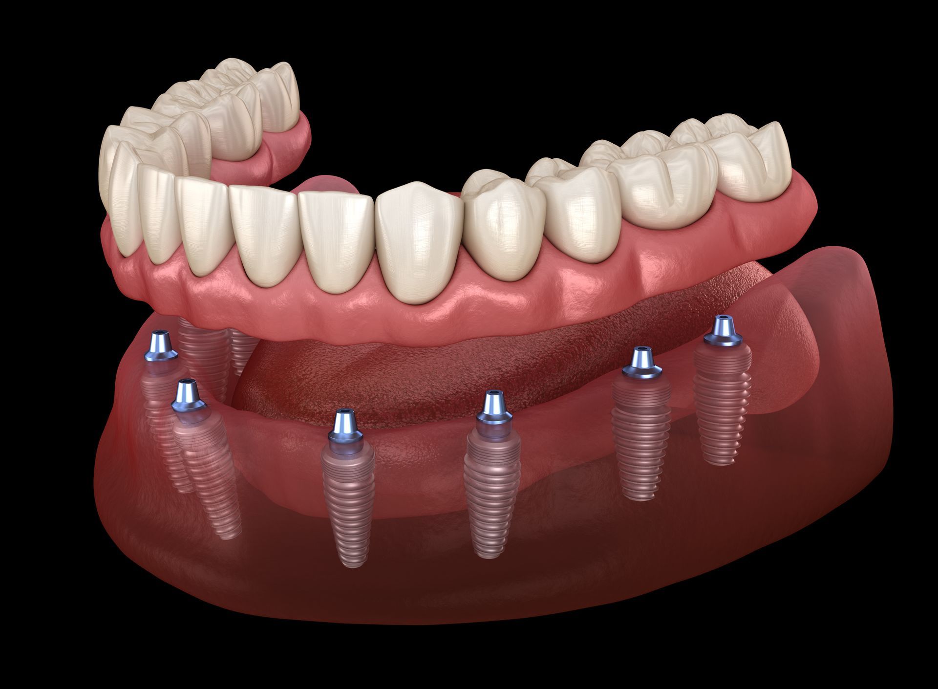 3D dental implant model with a pink gum arch and white teeth on a dark base
