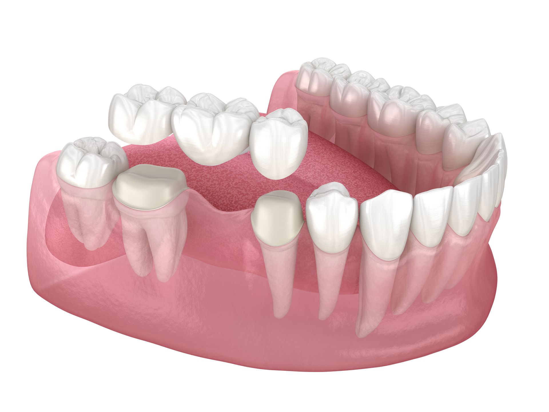 3D model of a lower jaw with teeth and pink gums, showing dental crowns and gaps