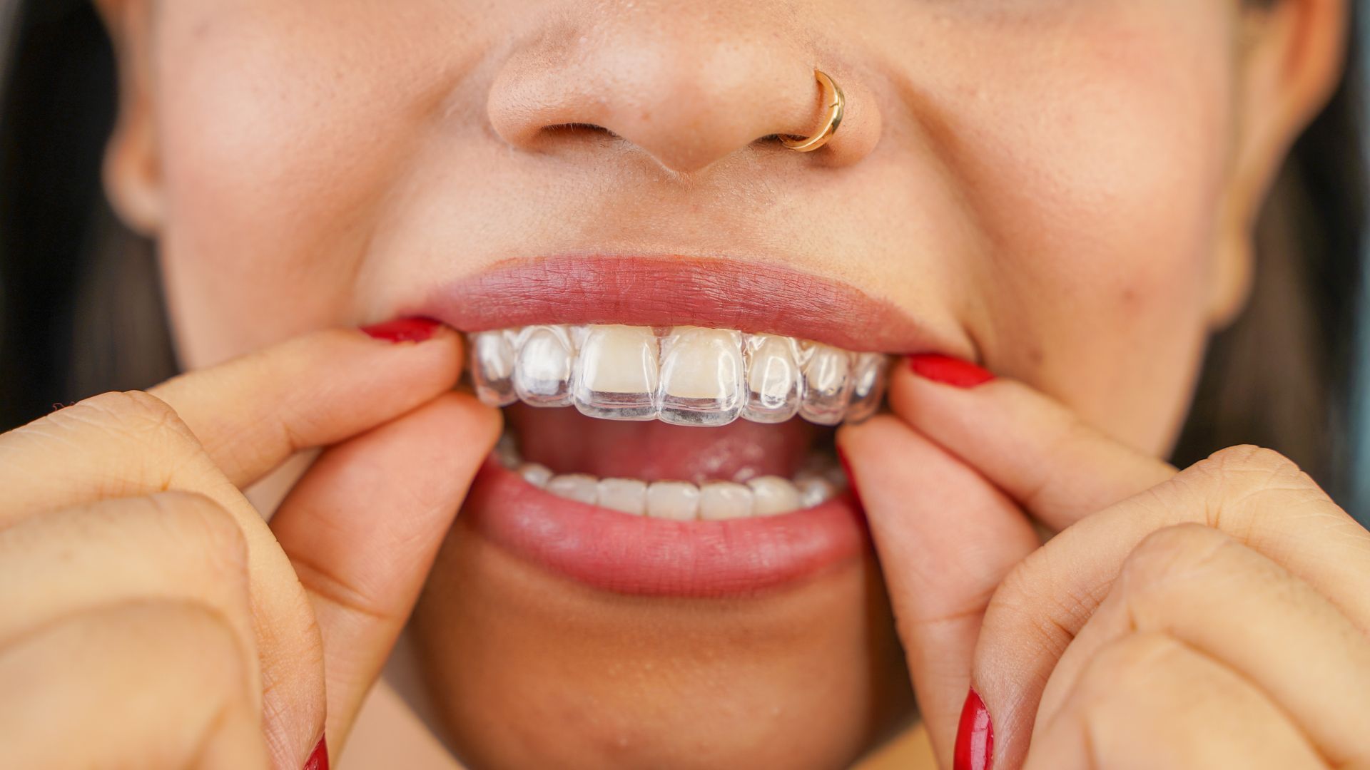 Person fitting a clear aligner over upper teeth, smiling close-up with hands on the mouth
