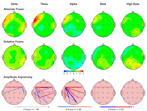 Quantitative Electroencephalography (qEEG)