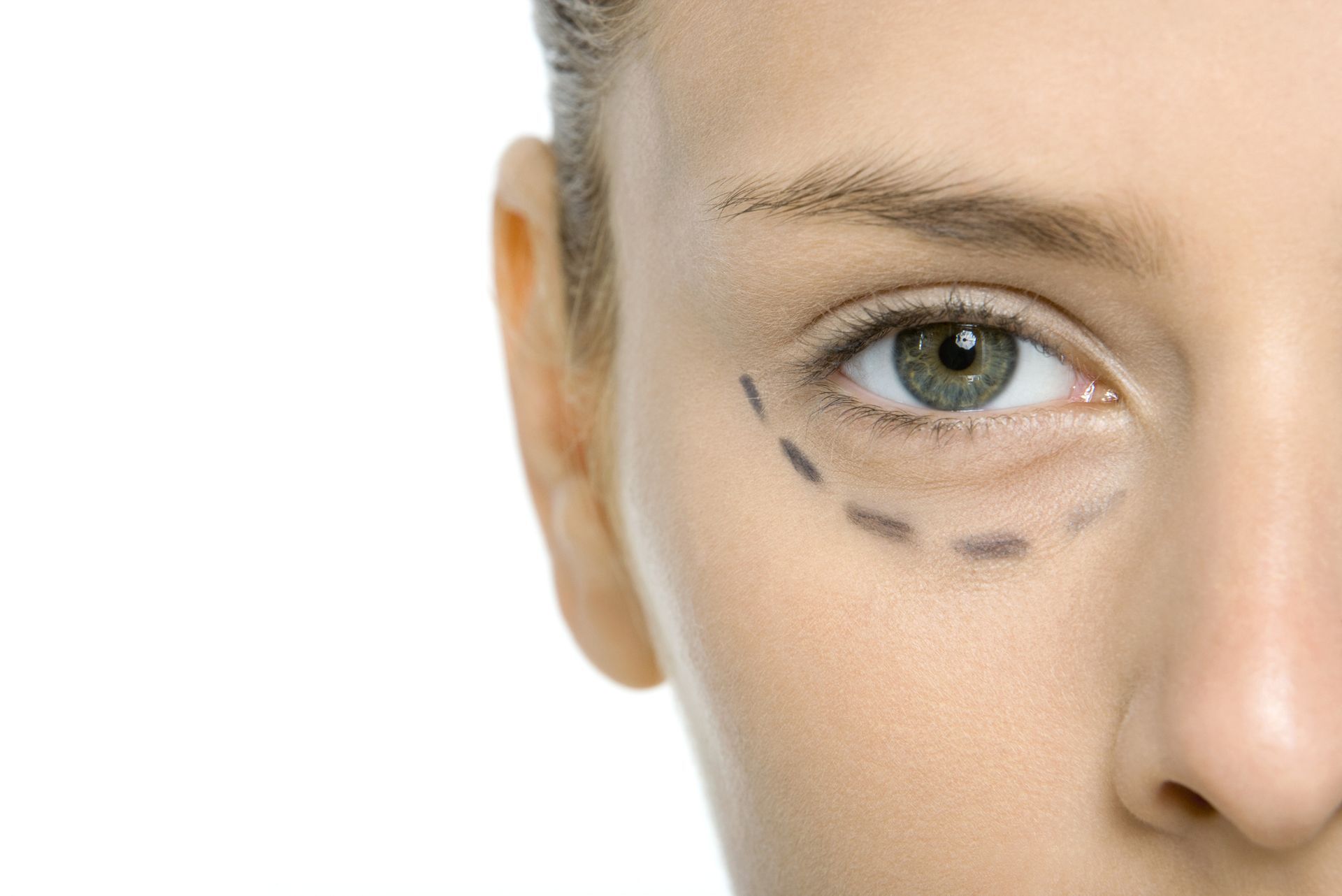 Close-up of an eye with a dashed line marked under the lower lid to indicate a surgical procedure.