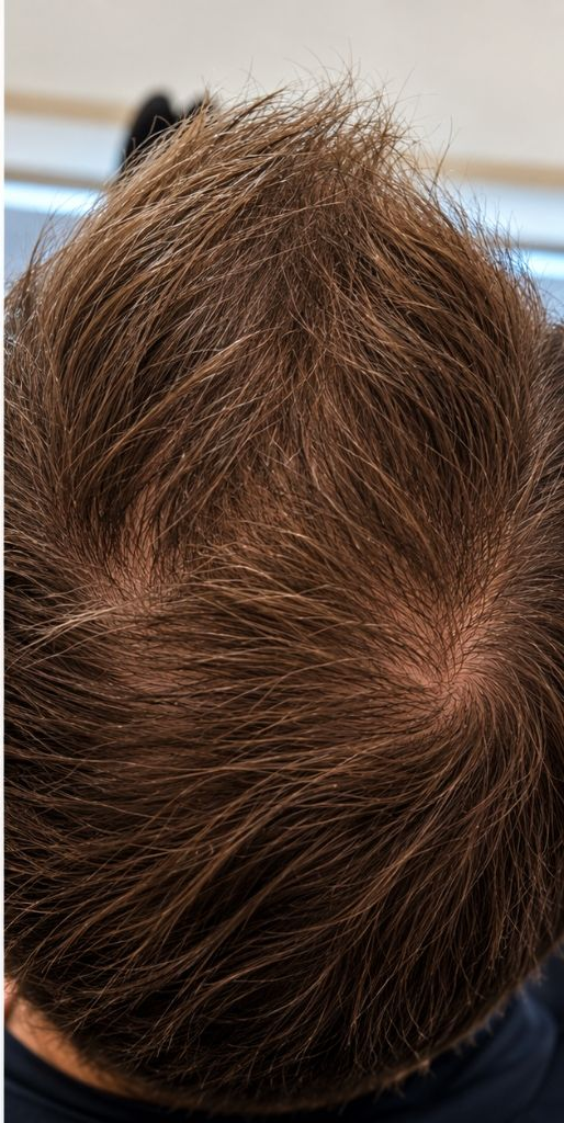 Top view of a person’s thinning brown hair on the crown of the head