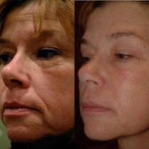 Before and after comparison of woman's face. Wrinkles reduced, smoother skin.