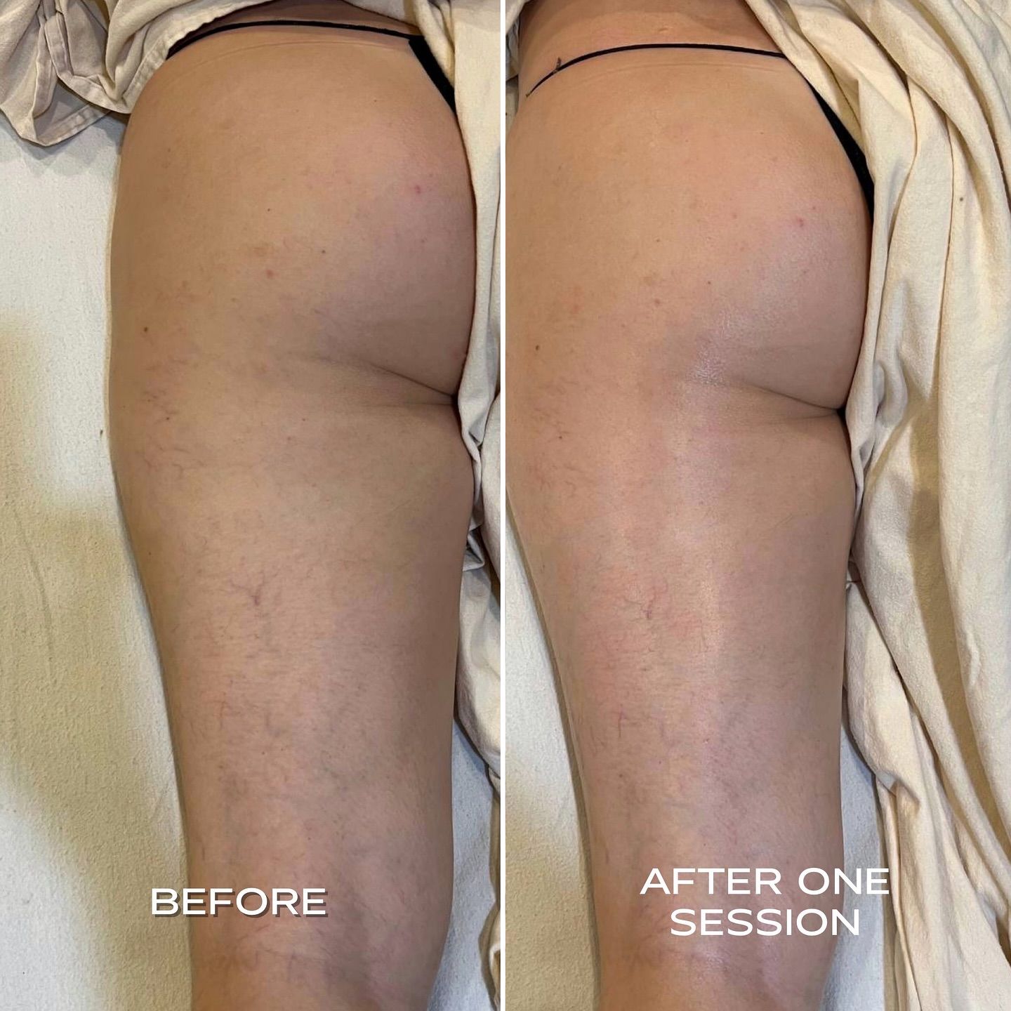 Side-by-side comparison of a person's thigh and buttock.