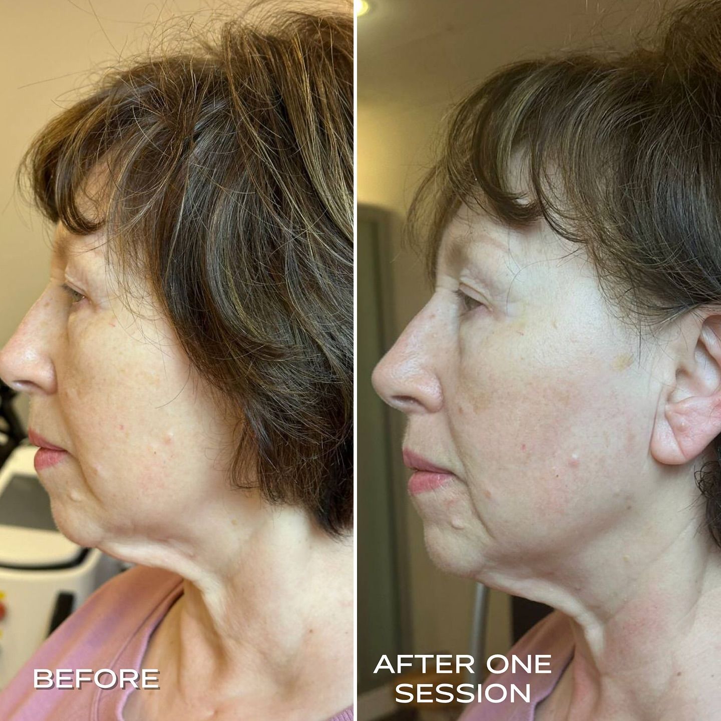 Side-by-side comparison of woman's profile before and after facial treatment