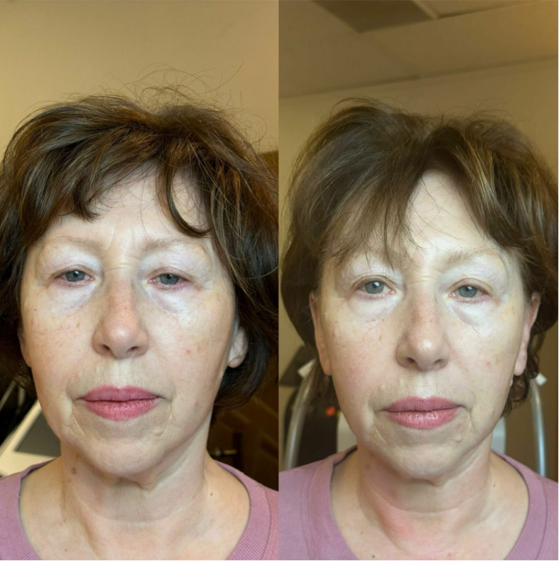 Before-and-after facial comparison of a woman with darker hair; left side has more wrinkles.