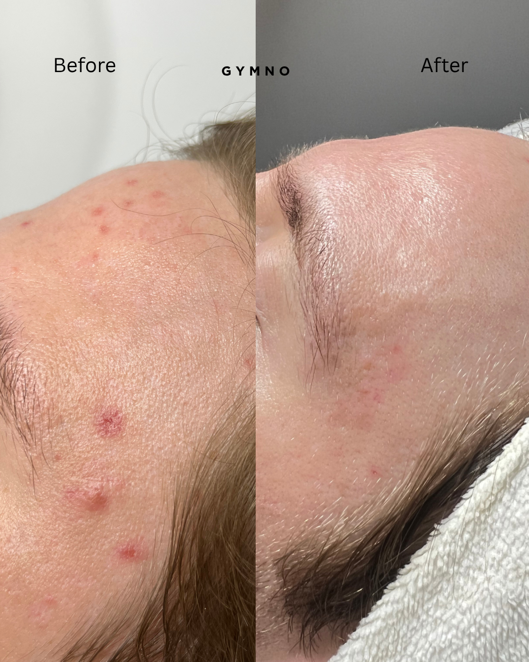 Acne facial in new york city
