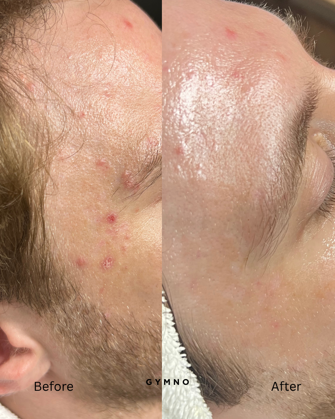 Soho acne facial results
