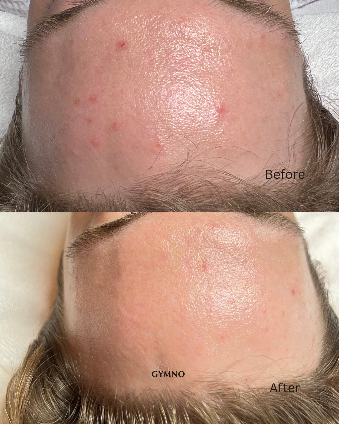 acne facial before and after