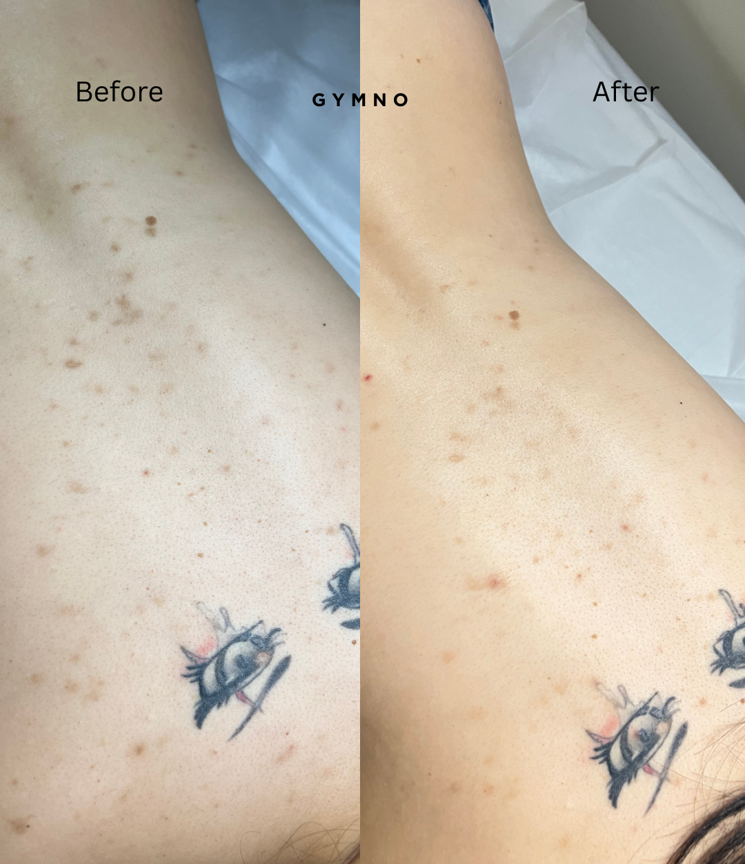 Back acne treatment in NYC
