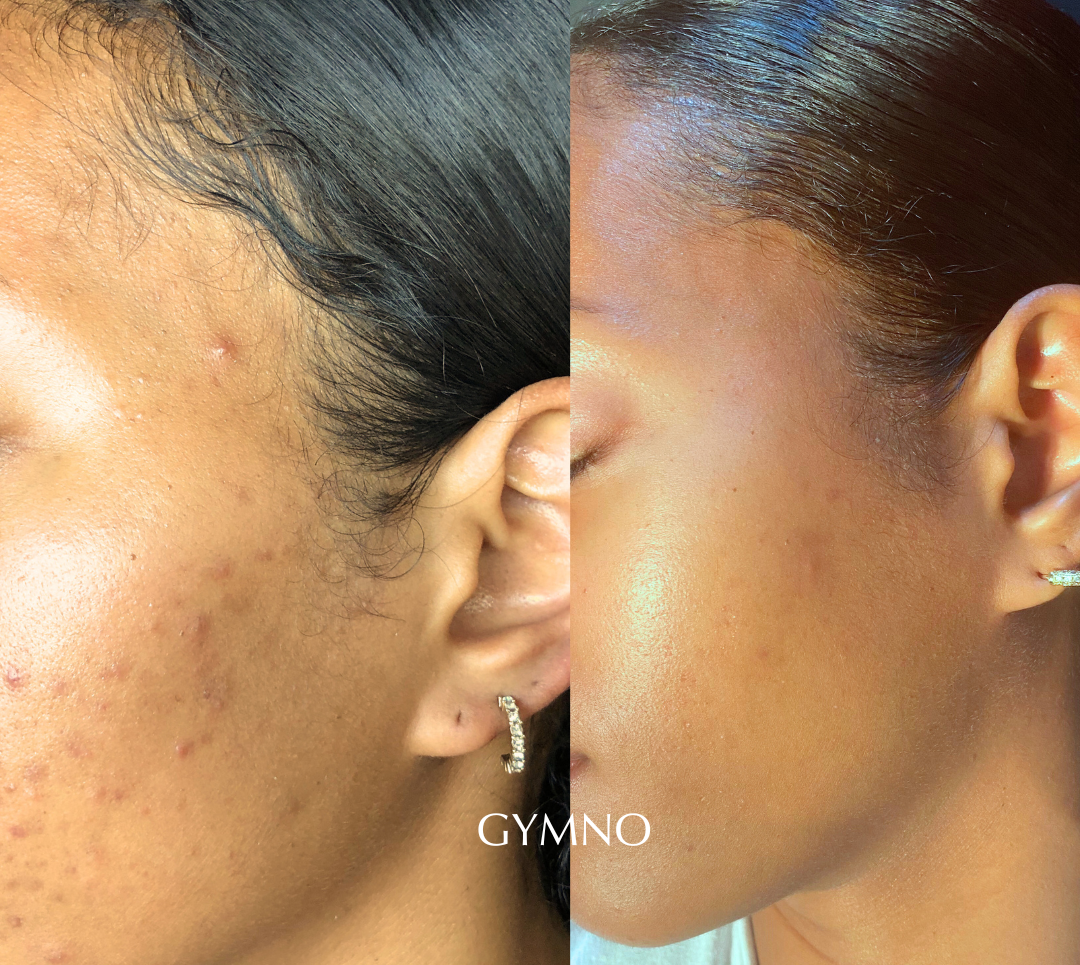 NYC acne facial results