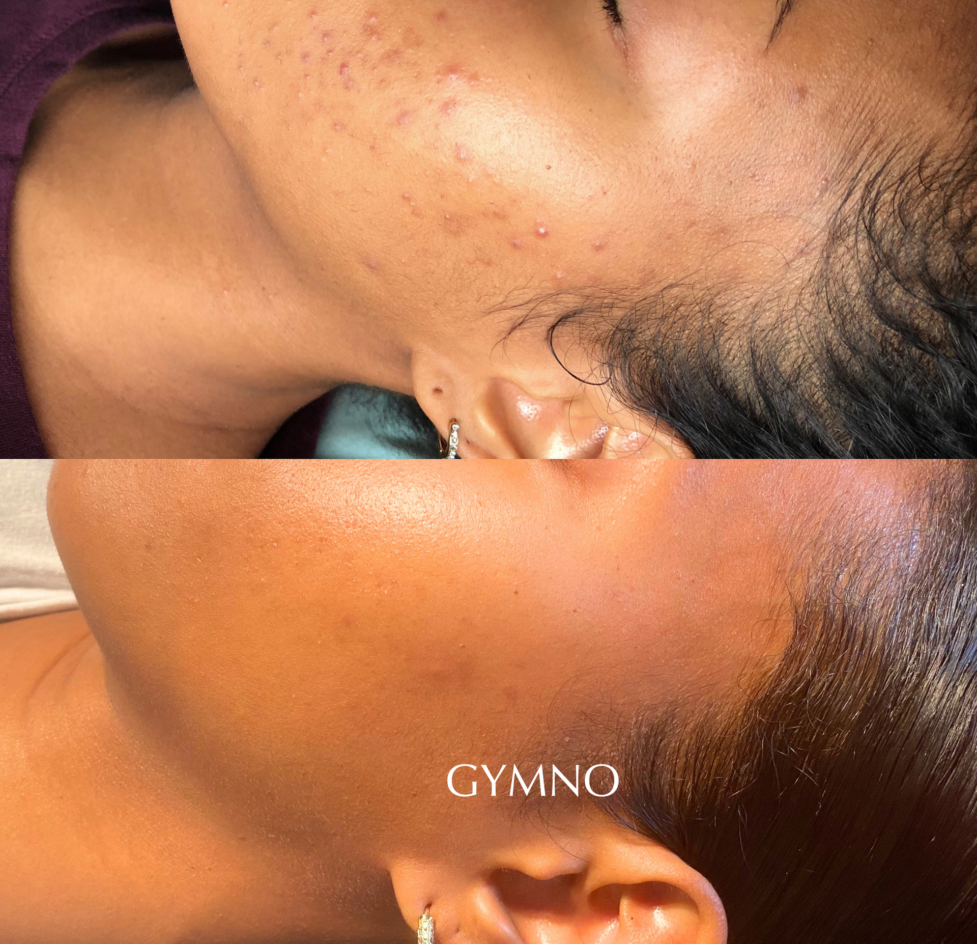 acne facial results SoHo