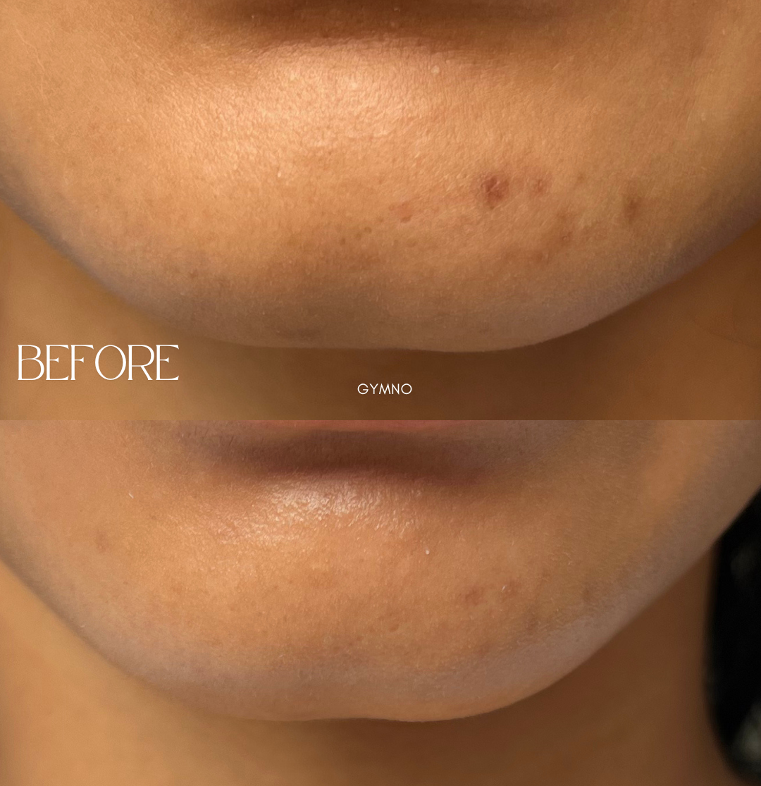 hyperpigmentation treatment NYC