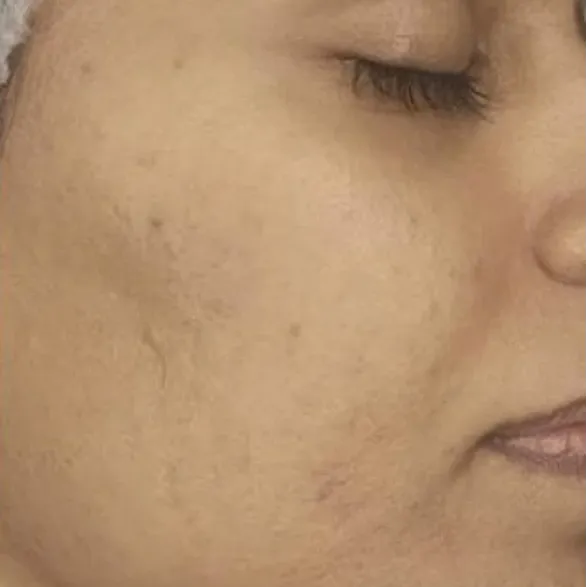 Nahaufnahme des Gesichts einer Person. Die Haut ist leicht verfärbt und hat sichtbare Poren. Die rechte Gesichtshälfte ist sichtbar.