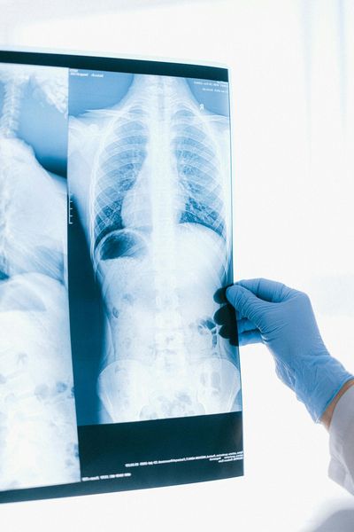 Person in a medical setting holding up and examining a chest X-ray.