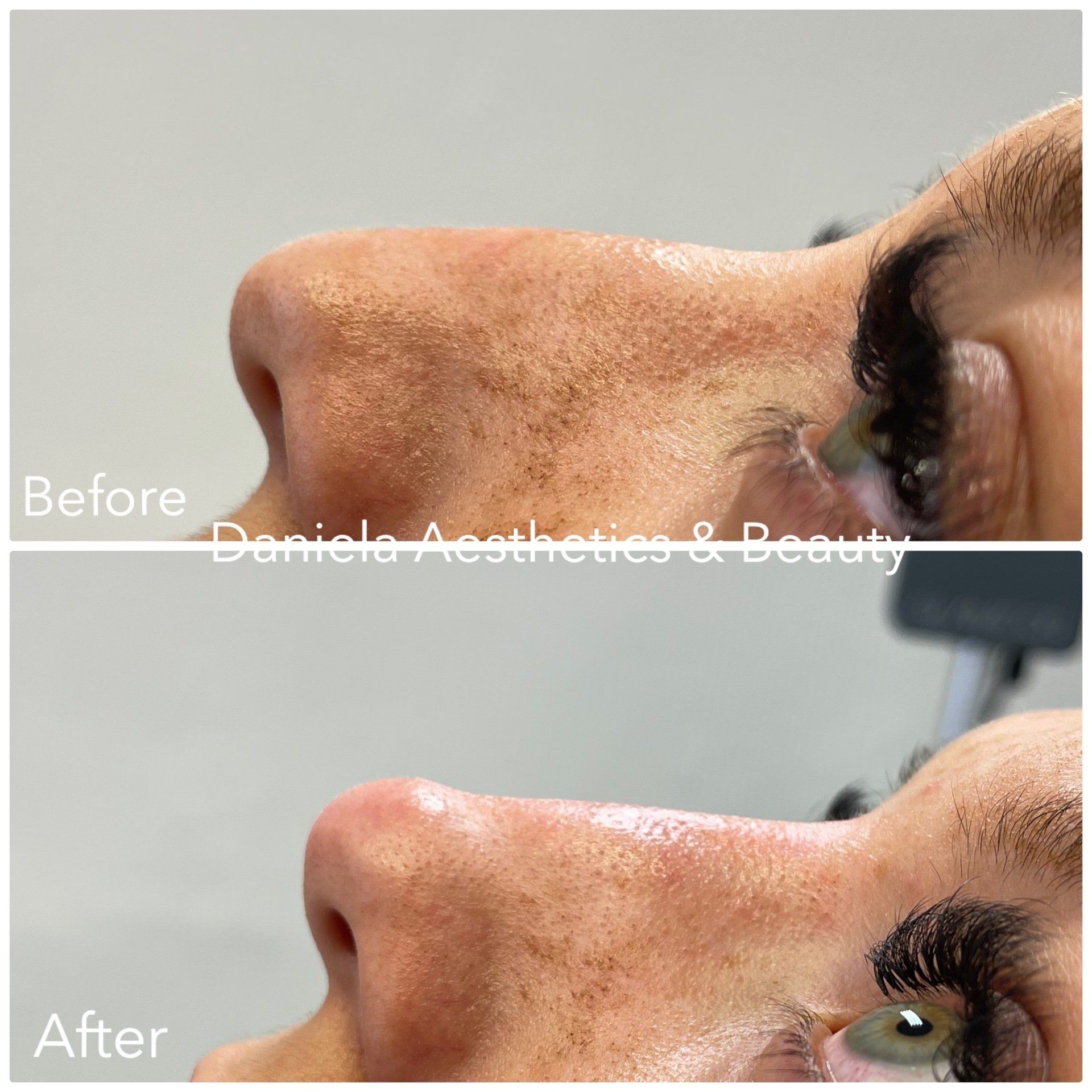 Nose filler