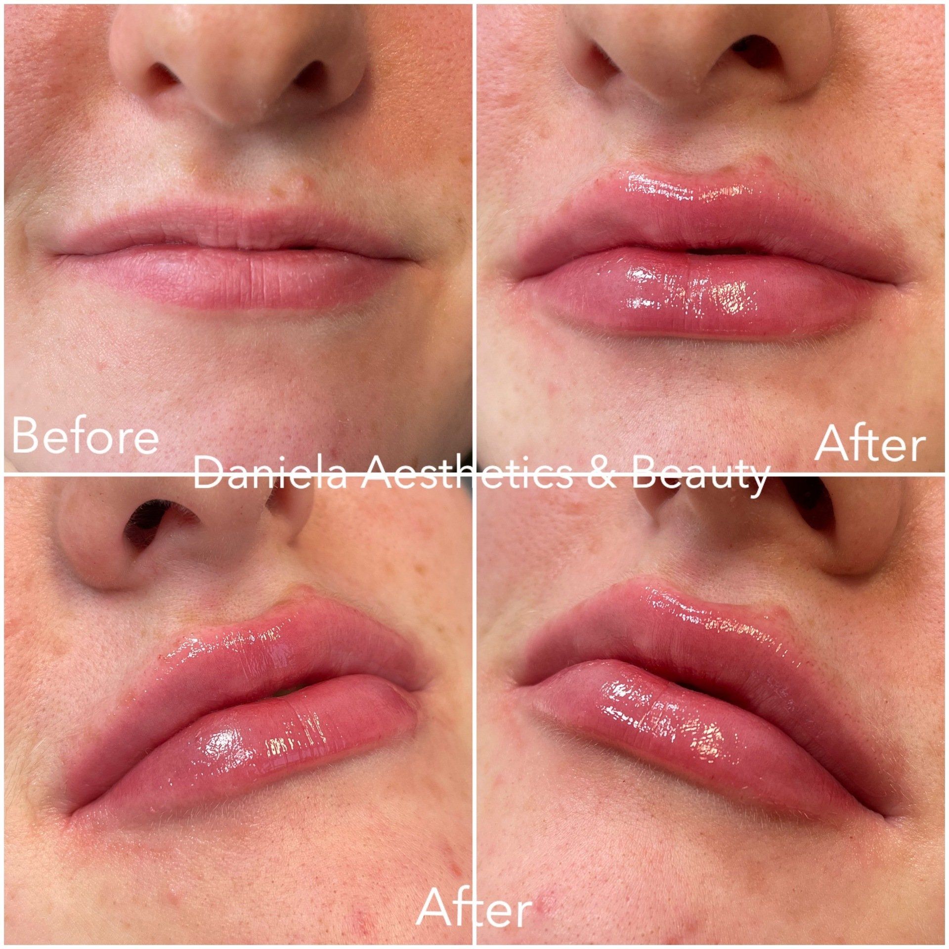 Dermal fillers