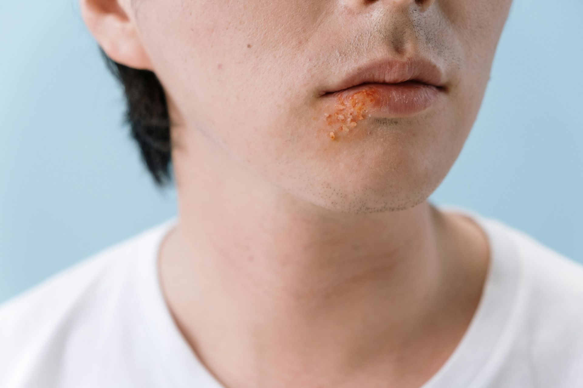 Close-up of a man with a cold sore on his lip.
