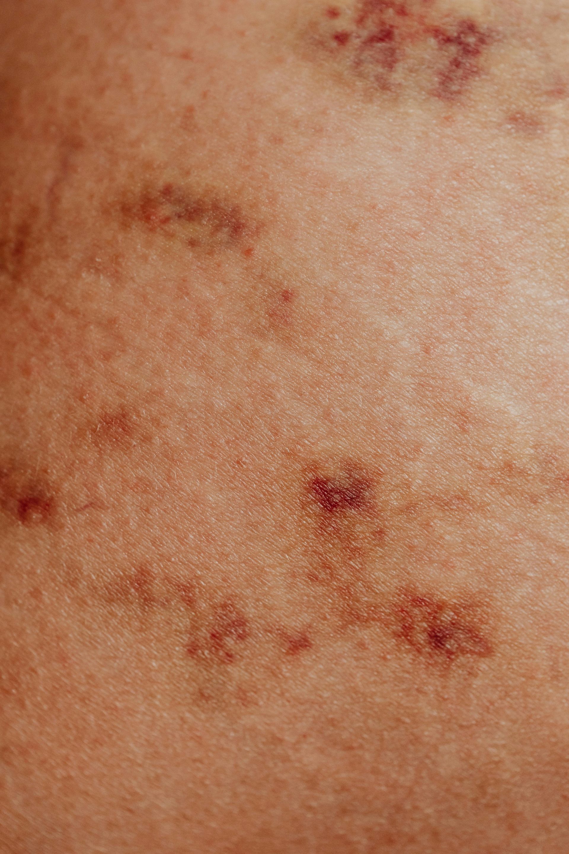 Skin with multiple small, reddish-purple bruises of varying shapes and sizes.