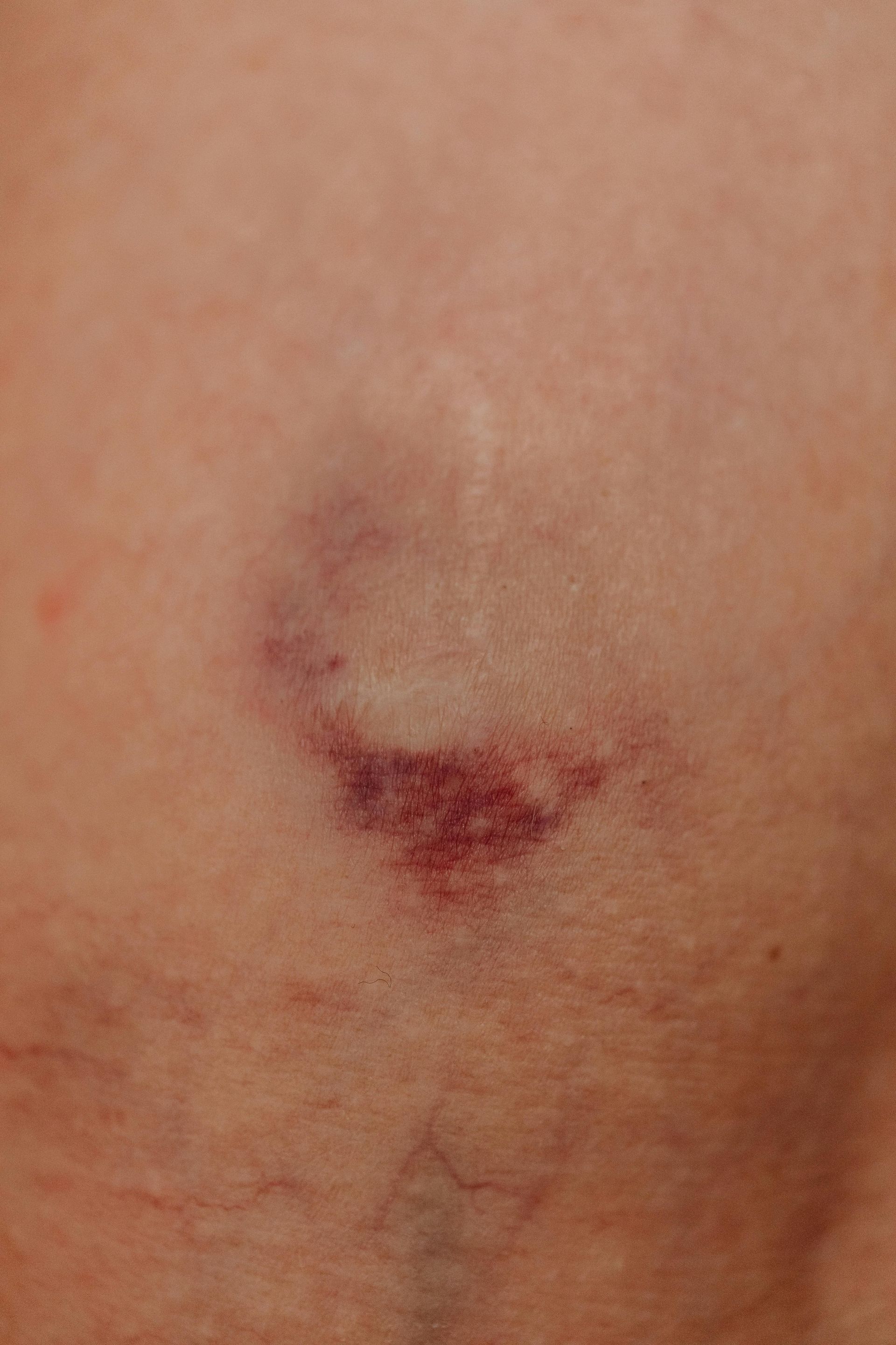 Bruise on skin, dark purple and red discoloration.