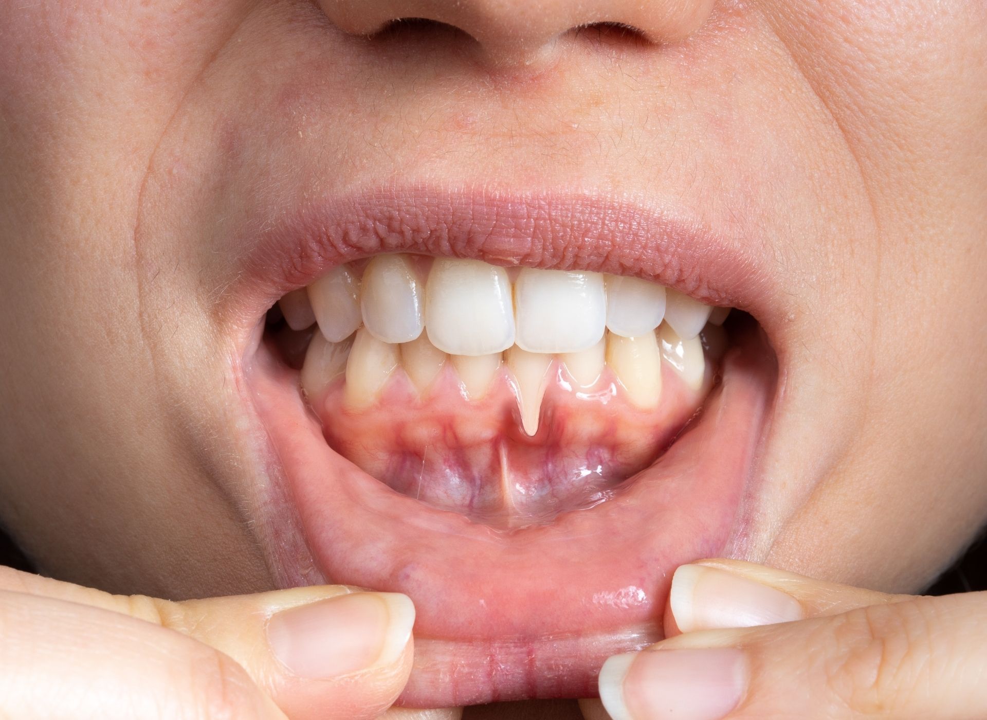Close-up of a mouth with a prominent band of gum tissue extending upward from the lower lip to between the lower teeth.