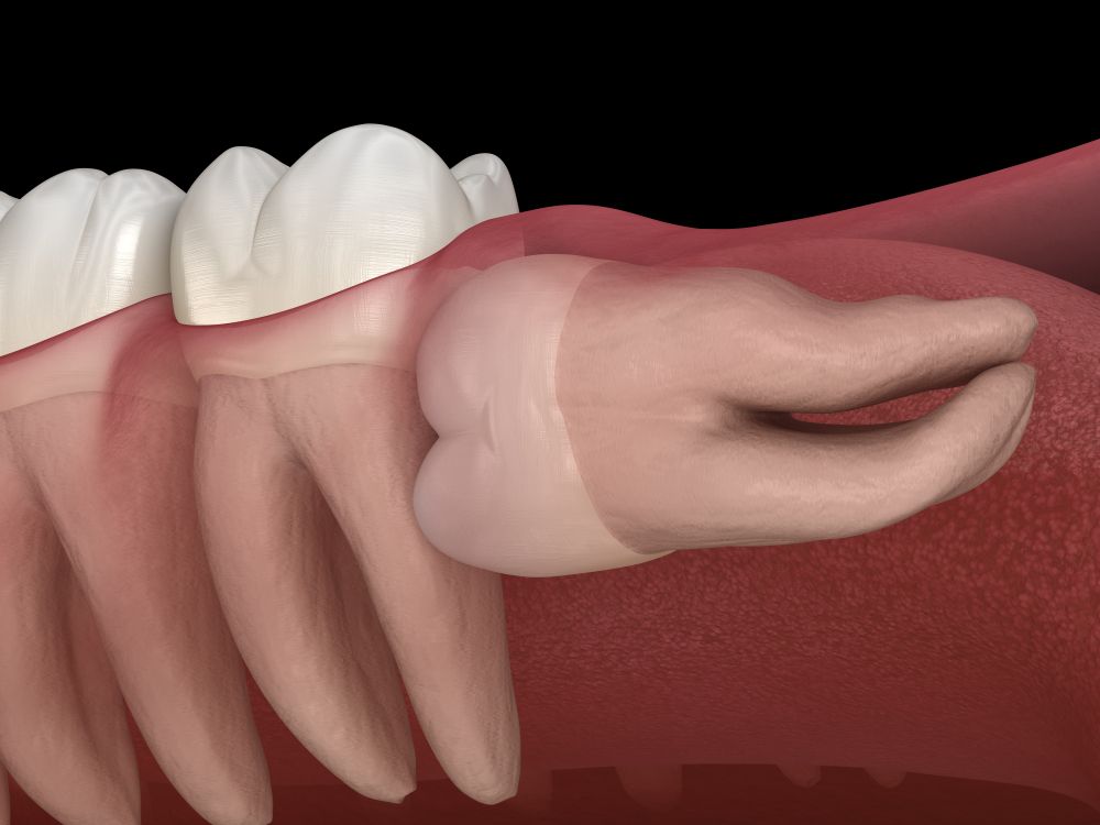 A 3D medical illustration showing a horizontally impacted wisdom tooth pressing against an adjacent molar.