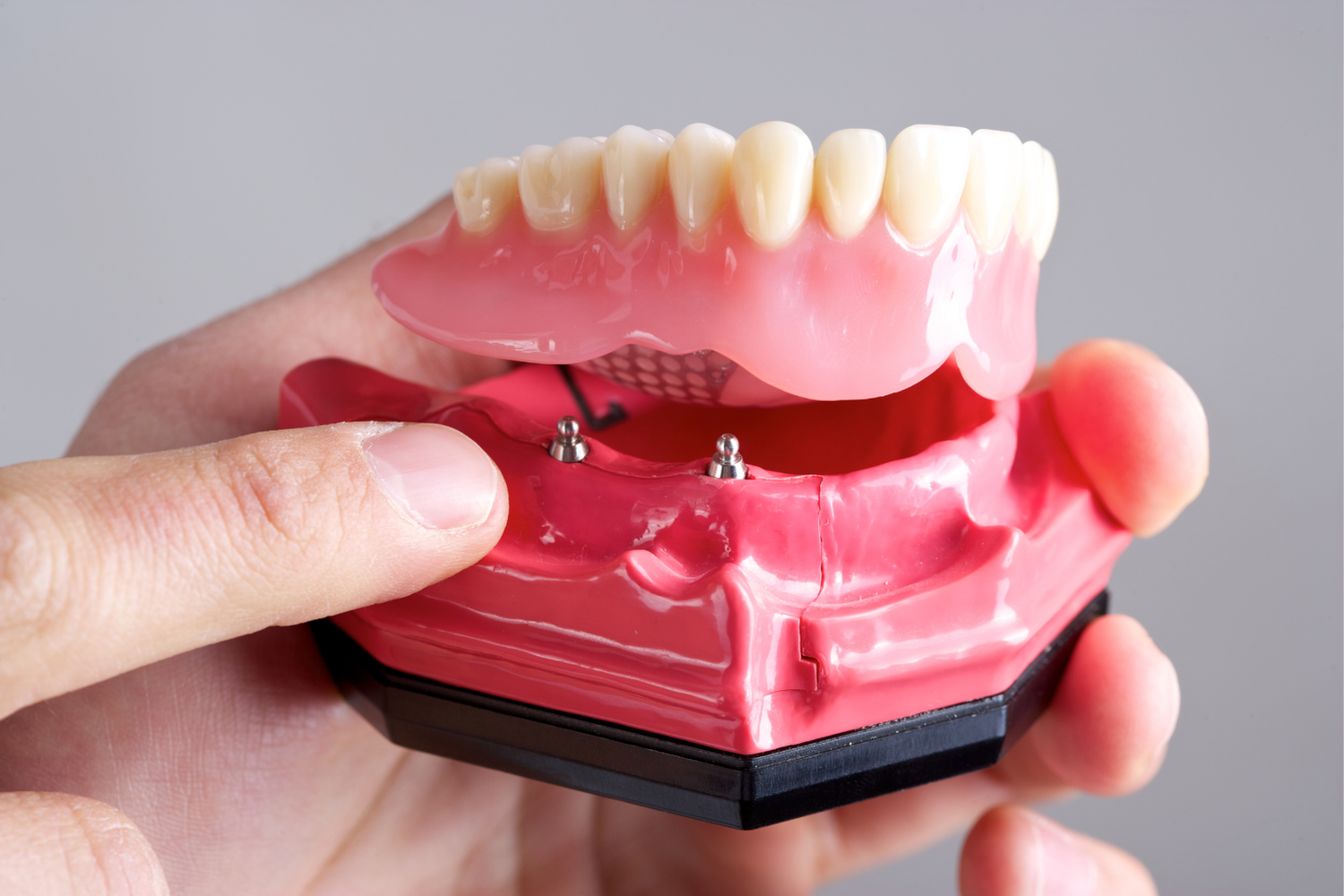 A dental model showing a removable overdenture being aligned with two ball-attachment implants on a pink gum base.