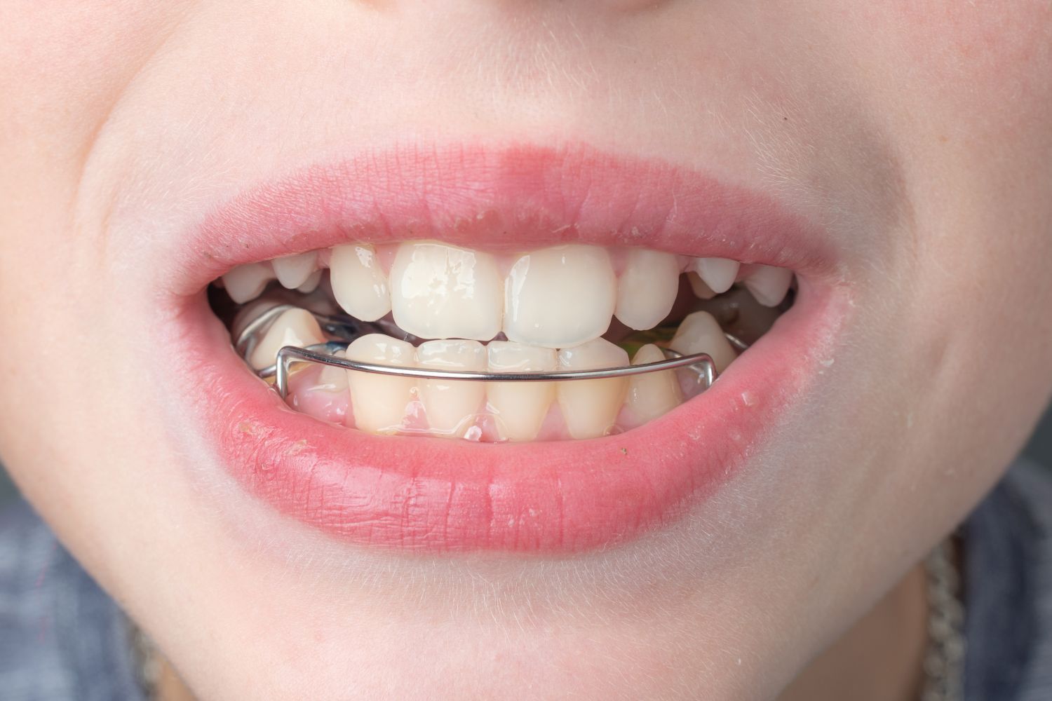 Close-up of a person's mouth showing a wire orthodontic retainer fitted across the lower teeth.