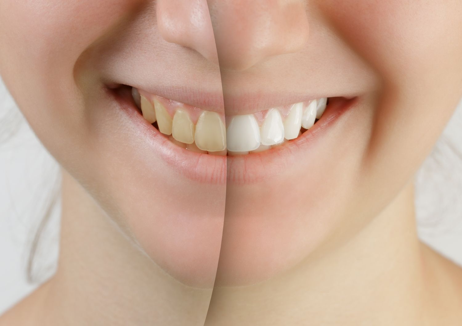 Split-screen close-up of a person's mouth comparing yellowed teeth on the left to professionally whitened teeth on the right.