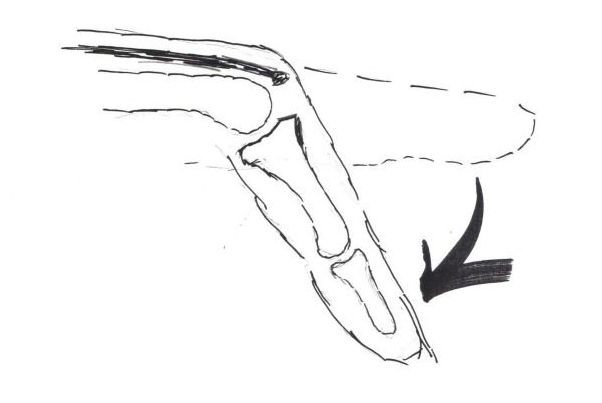 Grey Splint On Broken Finger — Irvine, CA — Perfect Fit Splints Grey Splint On Broken Finger — Irvine, CA — Perfect Fit Splints