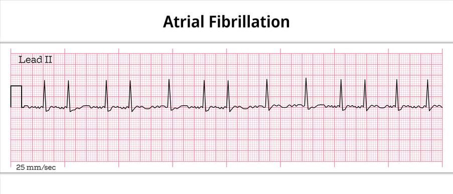 Atrial fibrillation ECG strip on pink graph paper with irregular heartbeat spikes