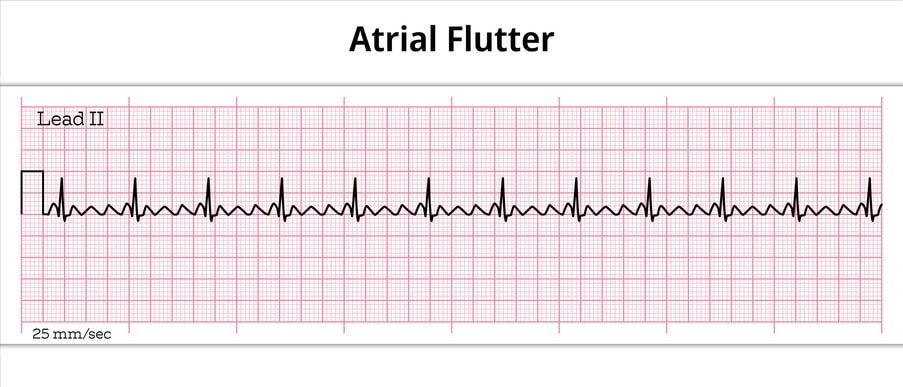 ECG strip labeled “Atrial Flutter” showing a pink heart rhythm waveform on grid paper.