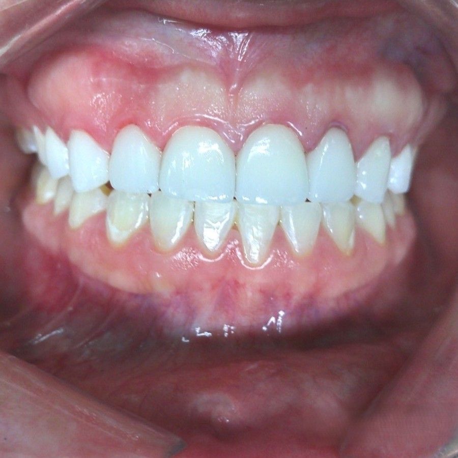 A patient's teeth after having a veneers procedure complete.