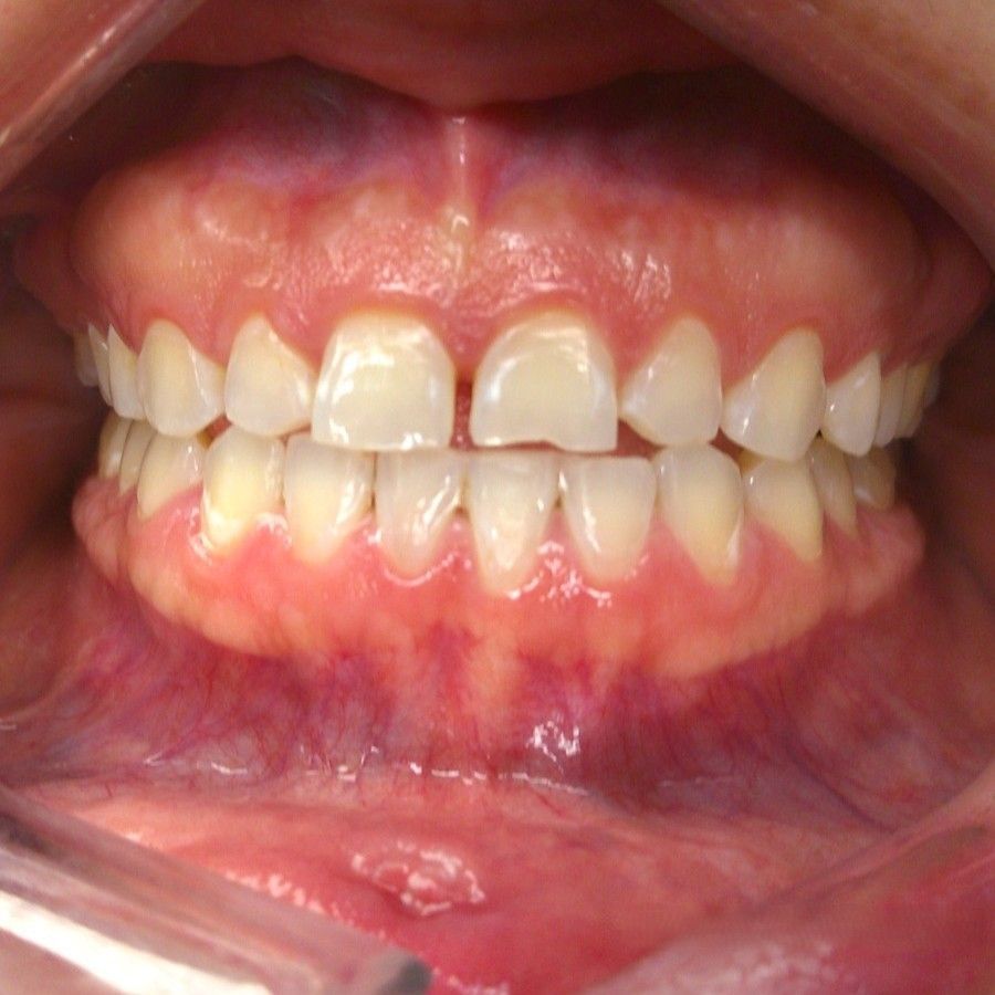 A patient's teeth after having a veneers procedure complete.