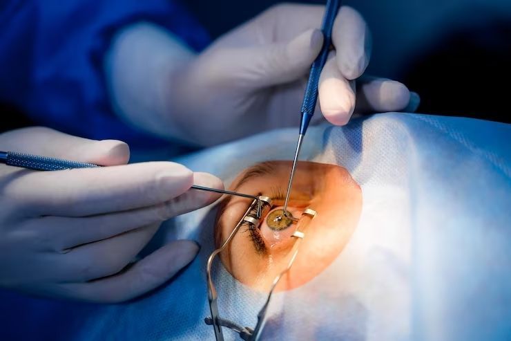 Cirurgia refrativa no Rio de Janeiro