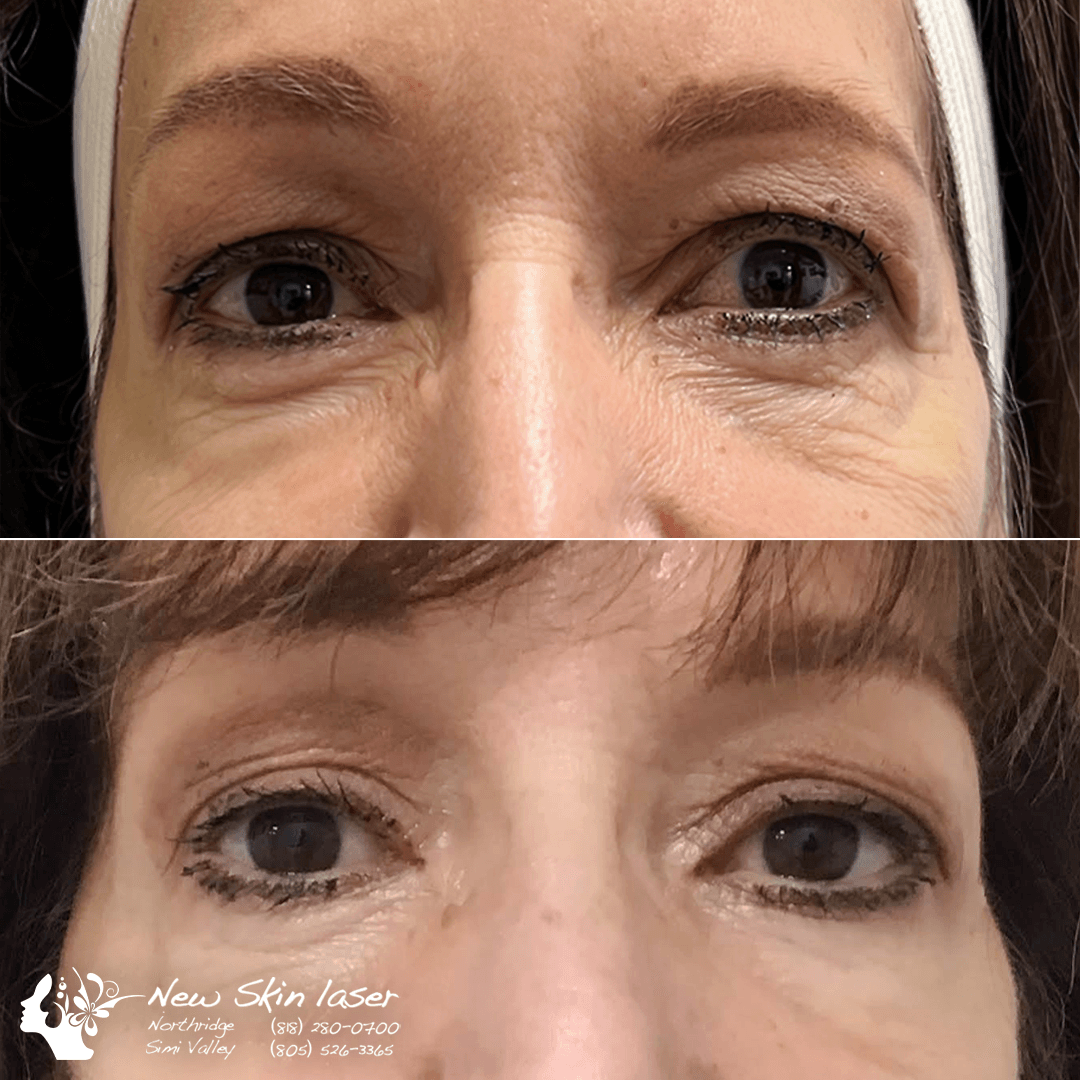 $50 Off Botox Rebate Special