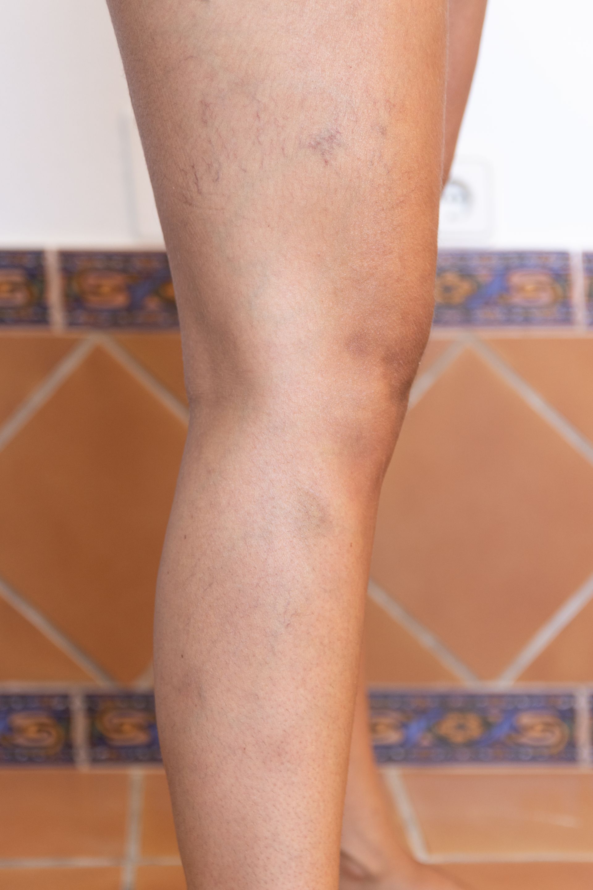 woman with spider veins