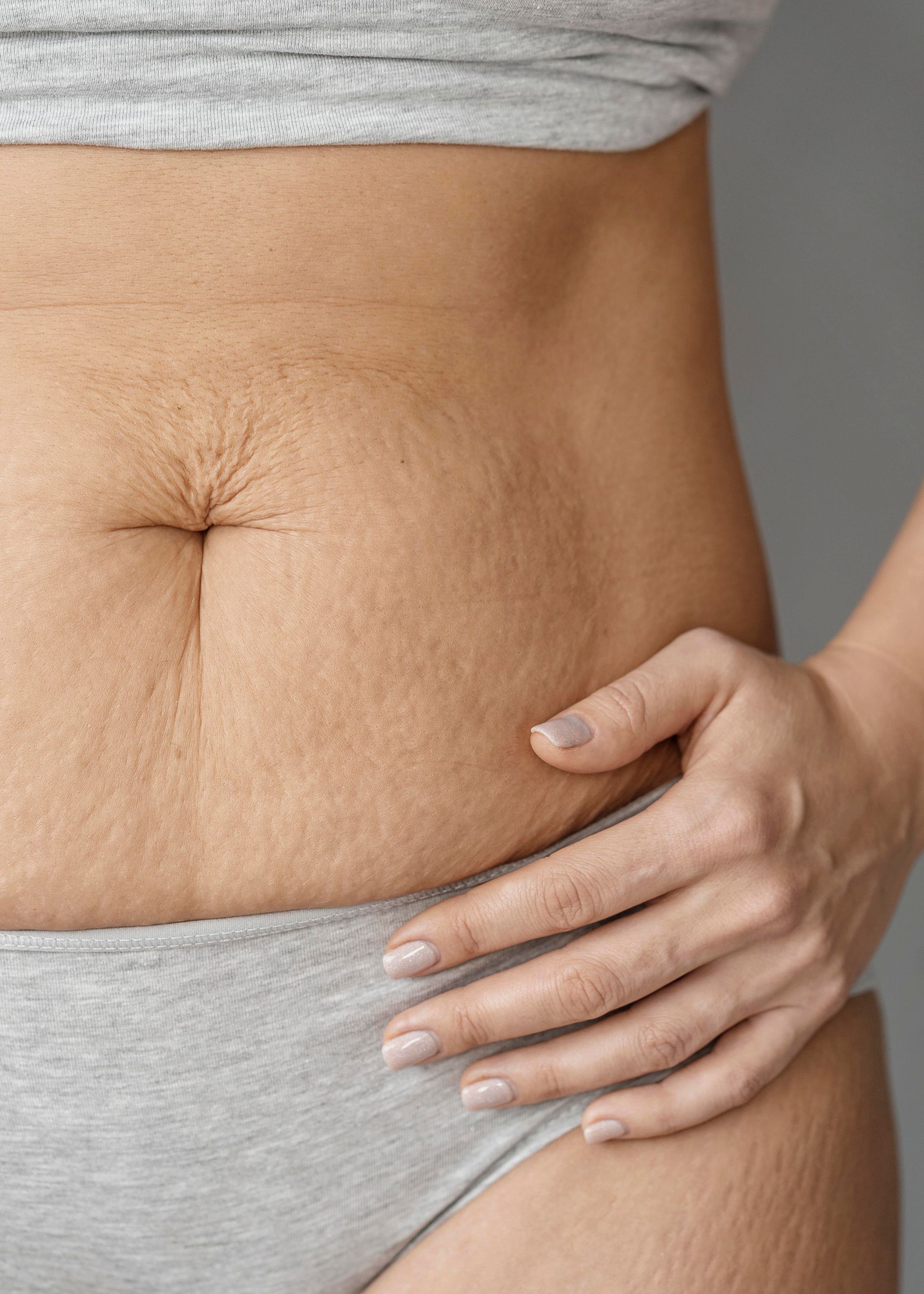 woman with stretch marks
